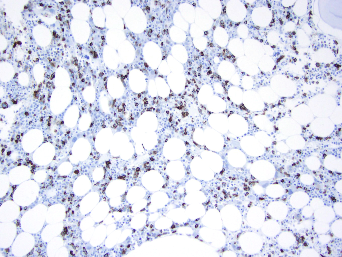 CD34 Immunohistochemical stain performed on the bone marrow core biopsy highlights many blasts.